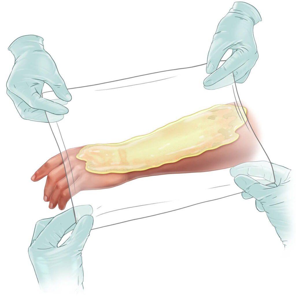 Application du gel de débridement enzymatique NexoBrid sur une brûlure de l'avant-bras